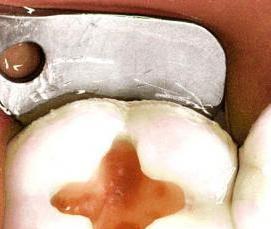 цементы на основе гидроксида кальция - тип 3