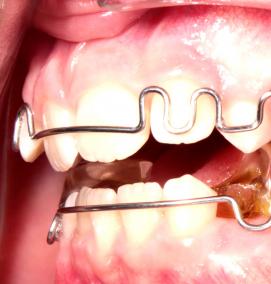 твинблок 300 - тип 1