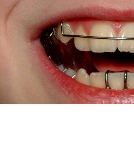 твинблок рефтинский - модель 3