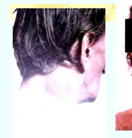 Визуализация лимфоузлов - тип 1