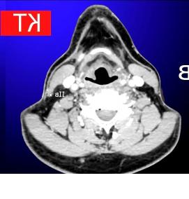 Визуализация лимфоузлов - тип 3