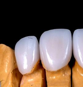 Восстановление коронок - тип 4