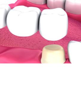 Восстановление коронок - тип 2