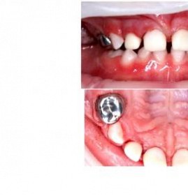 Восстановление коронок